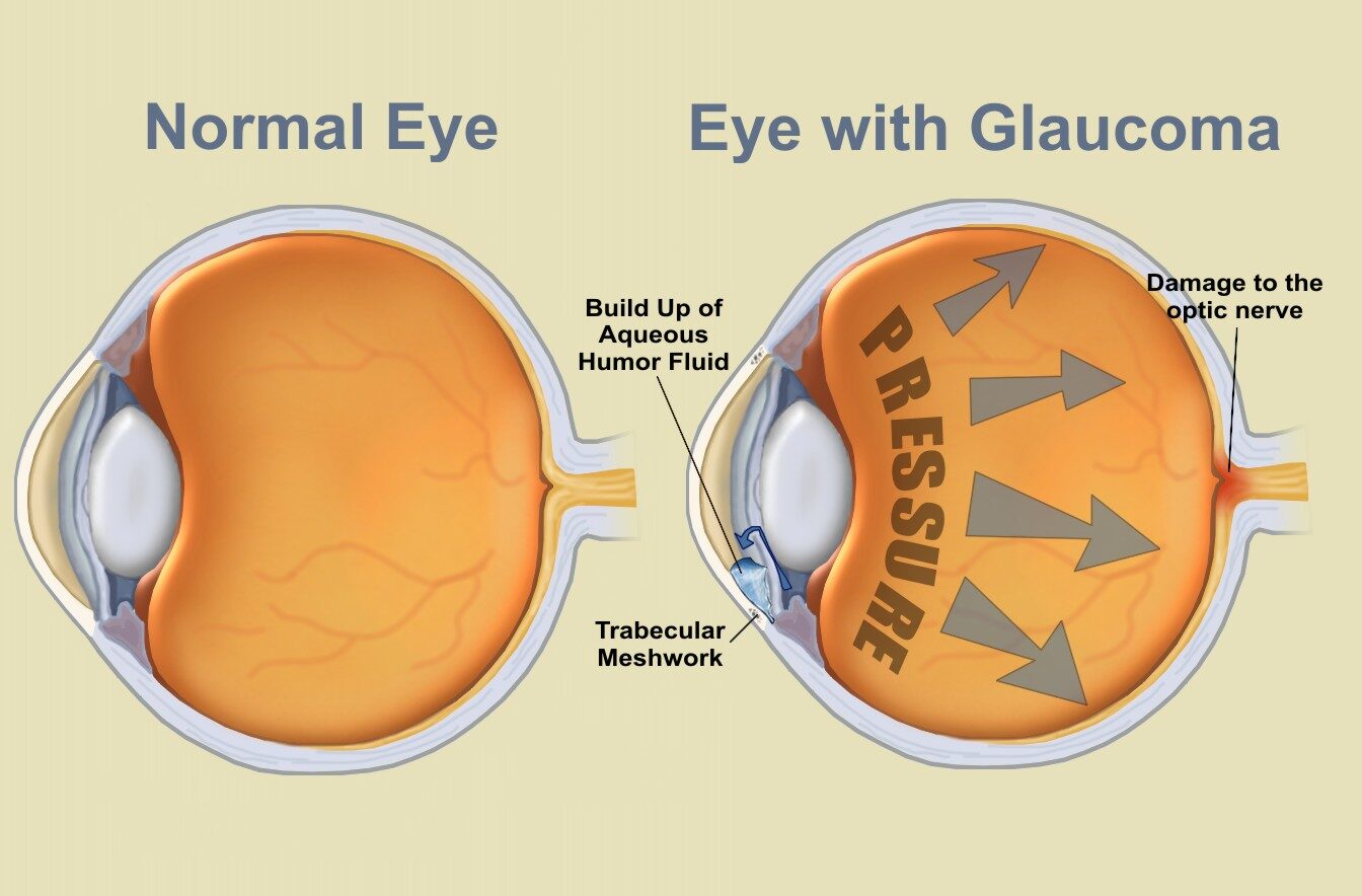Glaucoma Treatment in India